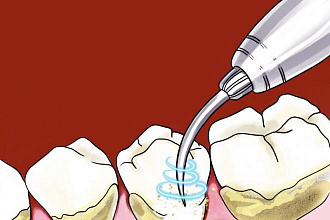 Статья по теме Зубная чистка ультразвуком