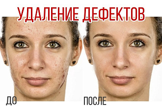 Удаление прыщей, морщин, шрамов и других дефектов